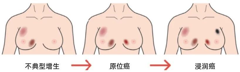 乳腺增生到底用不用治？身体出现这5个信号，立刻去检查！