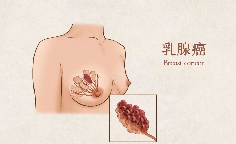 乳腺增生到底用不用治？身体出现这5个信号，立刻去检查！