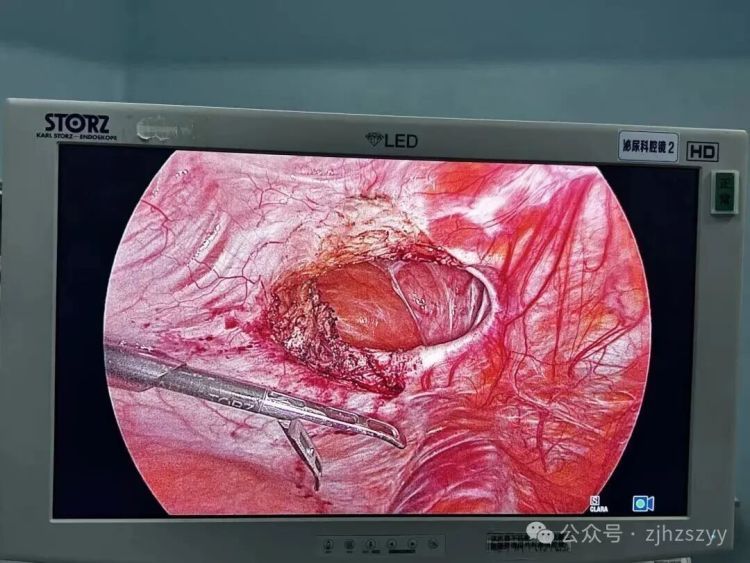 太可怕!杭州辣妈模仿明星,肚子练出“大洞”,医生紧急提醒 太可怕!杭州辣妈模仿明星,肚子练出“大洞”,医生紧急提醒