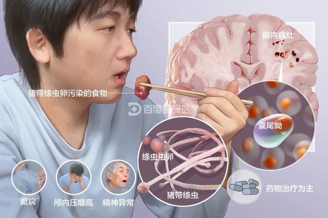 一口下肚，竟让寄生虫钻进大脑！医生郑重提醒：别生吃！