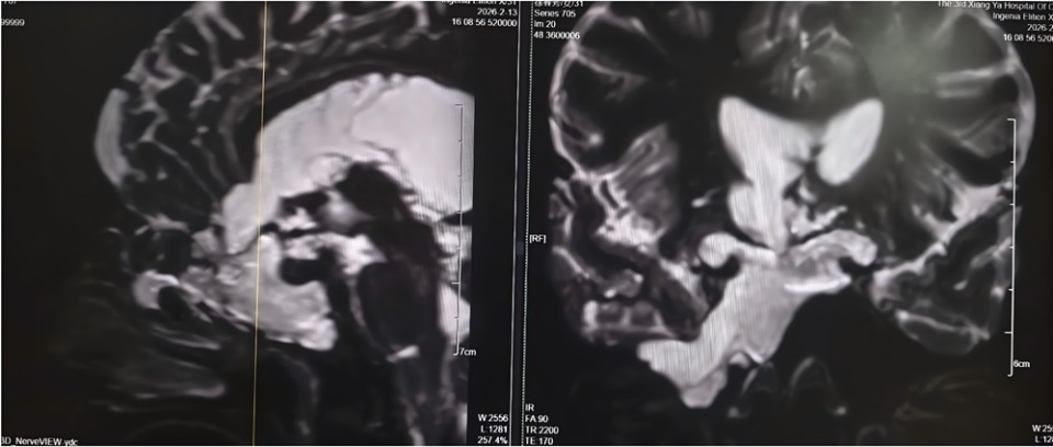 女子“脑子漏水”长达4年,最终神志模糊险丧命!专家:流清水鼻涕或是颅内“预警” 女子“脑子漏水”长达4年,最终神志模糊险丧命!专家:流清水鼻涕或是颅内“预警”