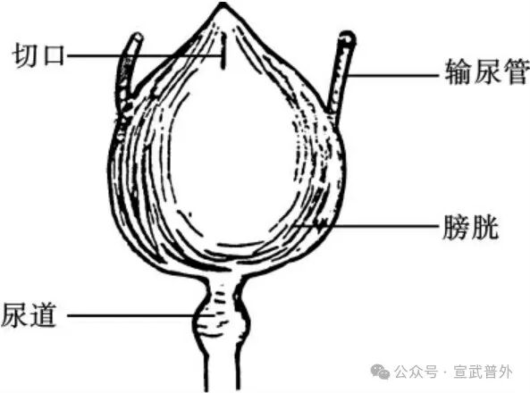 小心！酒后憋尿，膀胱可能“炸毛”
