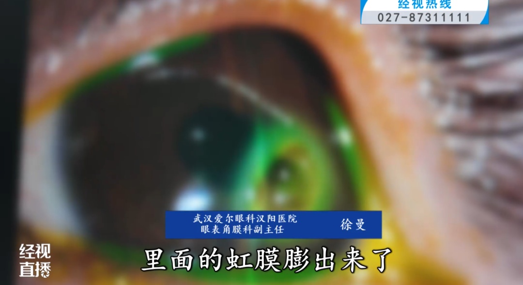 家长忽视螨虫问题,5岁女童角膜穿孔!医生:8根睫毛里竟藏着近20条螨虫 家长忽视螨虫问题,5岁女童角膜穿孔!医生:8根睫毛里竟藏着近20条螨虫