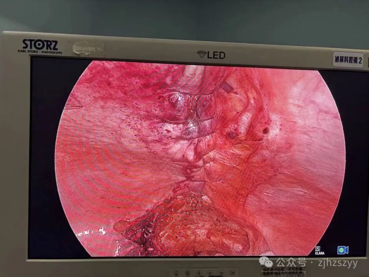 太可怕!杭州辣妈模仿明星,肚子练出“大洞”,医生紧急提醒 太可怕!杭州辣妈模仿明星,肚子练出“大洞”,医生紧急提醒