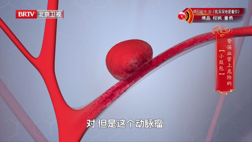 39岁网红“王炸姐”直播时突发脑出血离世：发病前有5个机会，抓住一个都能救命