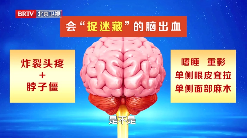 39岁网红“王炸姐”直播时突发脑出血离世：发病前有5个机会，抓住一个都能救命