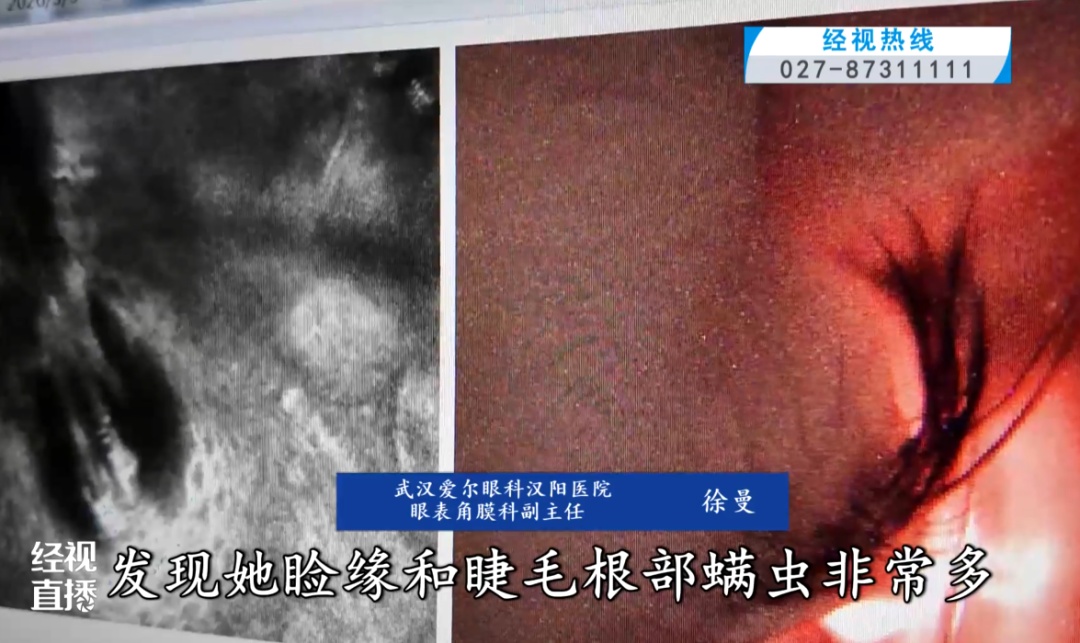 家长忽视螨虫问题,5岁女童角膜穿孔!医生:8根睫毛里竟藏着近20条螨虫 家长忽视螨虫问题,5岁女童角膜穿孔!医生:8根睫毛里竟藏着近20条螨虫