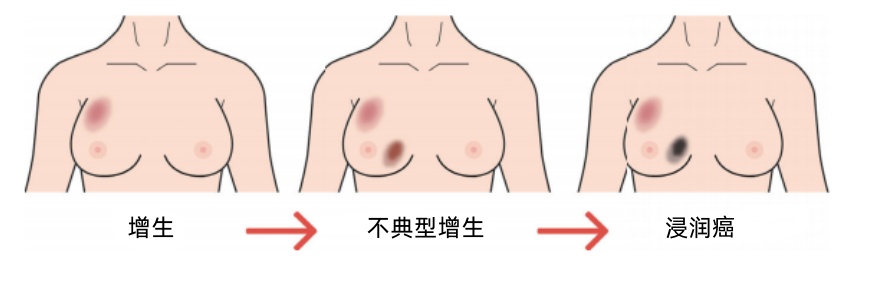 乳腺增生到底用不用治？身体出现这5个信号，立刻去检查！