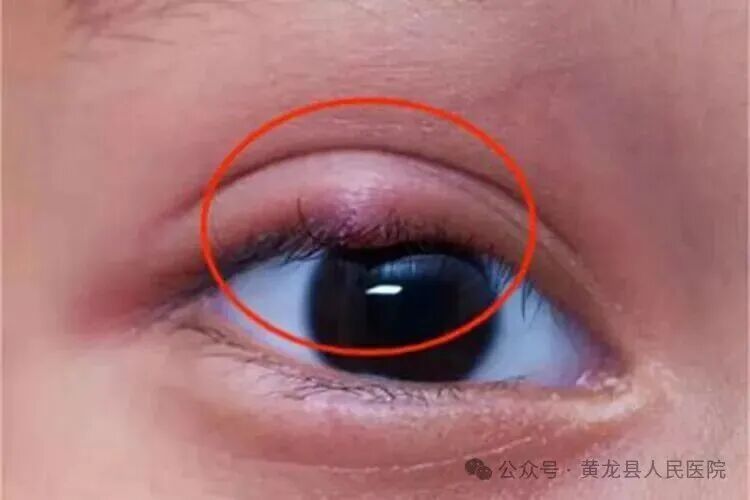 广东佛山一男子把麦粒肿当痘痘挤，眼睛差点“报废”，医生提醒
