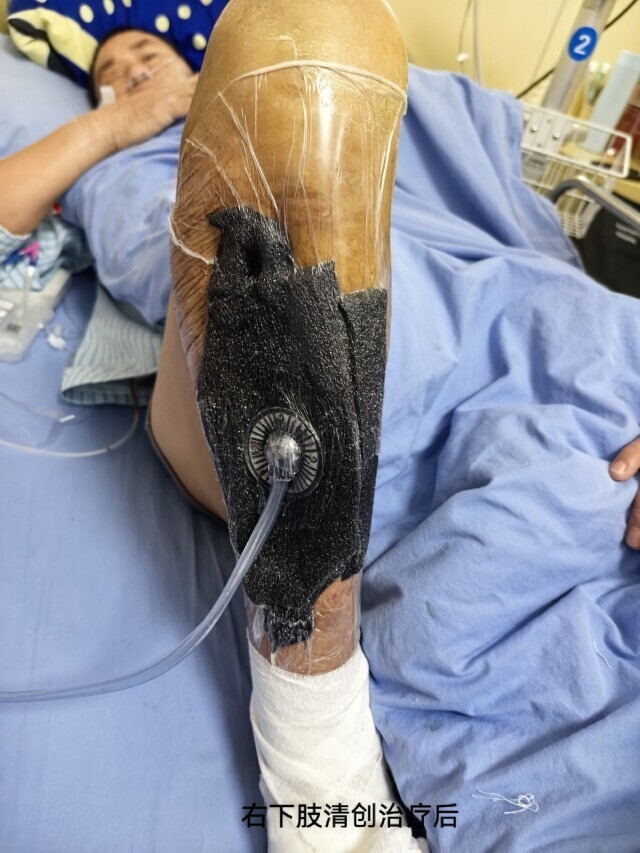 55岁男子突发高热、全身发黄，眼睛胀痛下肢感染！专家：病情凶险和多年糖尿病有关