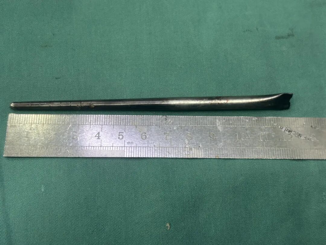 男子误吞12厘米金属筷子，忍了8年才取出，外露部分约3厘米