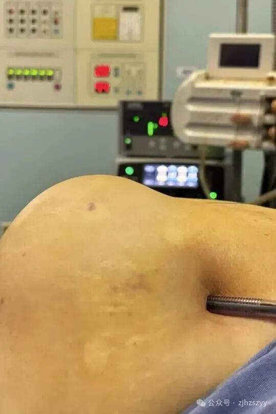 太可怕!杭州辣妈模仿明星,肚子练出“大洞”,医生紧急提醒 太可怕!杭州辣妈模仿明星,肚子练出“大洞”,医生紧急提醒