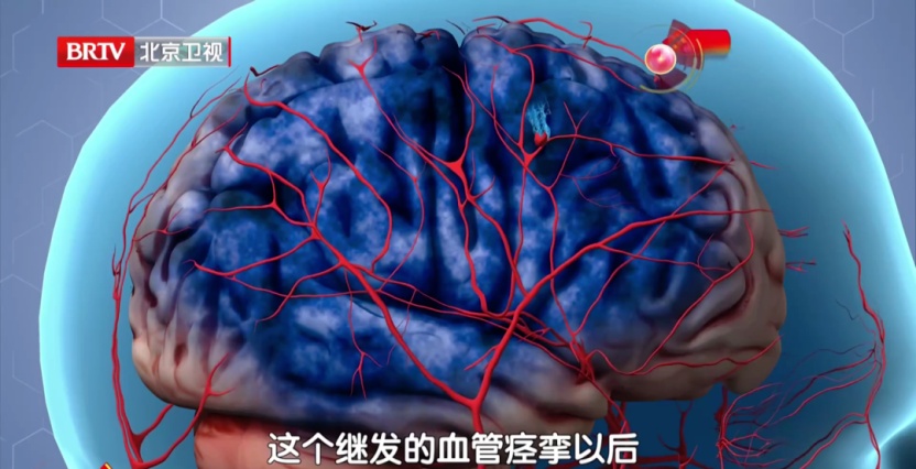 39岁网红“王炸姐”直播时突发脑出血离世：发病前有5个机会，抓住一个都能救命