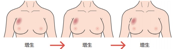 乳腺增生到底用不用治？身体出现这5个信号，立刻去检查！