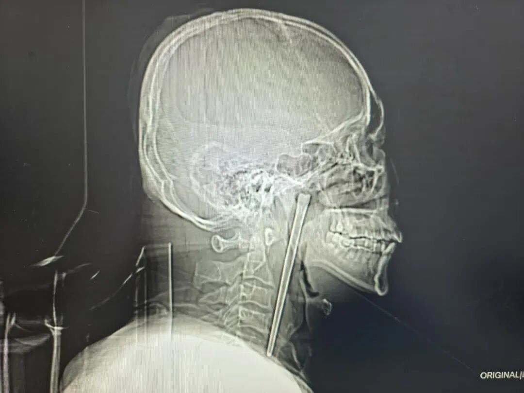 大连46岁男子咽部“藏”12厘米金属筷子，时间长达8年：偶感不适，以为饮酒后正常反应