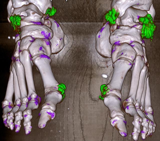 炸鸡配冰饮,爽一时痛一生!这种“富贵病”严重可致截肢,千万别大意 炸鸡配冰饮,爽一时痛一生!这种“富贵病”严重可致截肢,千万别大意