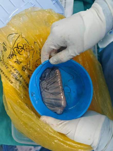 患者因好奇吞服水银,医院紧急手术 患者因好奇吞服水银,医院紧急手术