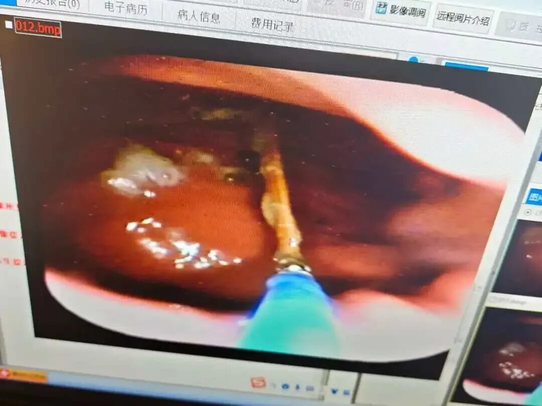 千万别再这样喝水!男子误吞牙签险穿肠,医院紧急接诊 千万别再这样喝水!男子误吞牙签险穿肠,医院紧急接诊