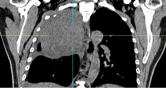 52岁男子咳嗽3个月老不好，到医院一查发现16cm巨型肿瘤
