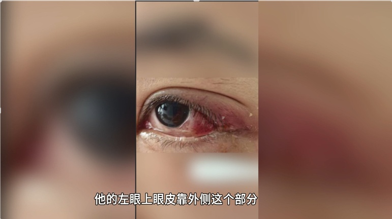 男子将眼旁麦粒肿当痘痘挤，眼睛差点“报废”