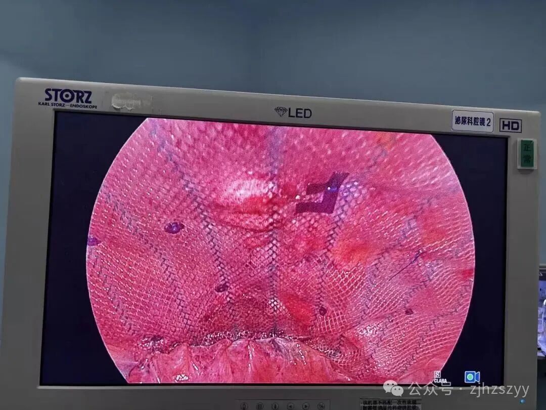 太可怕! 辣妈模仿明星,,肚子练出“大洞”肠子跑出来了…医生紧急提醒:普通人不要学 太可怕! 辣妈模仿明星,,肚子练出“大洞”肠子跑出来了…医生紧急提醒:普通人不要学