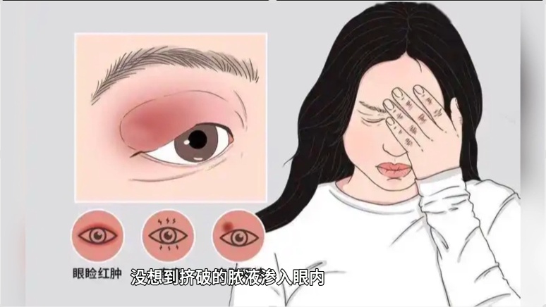 男子将眼旁麦粒肿当痘痘挤，眼睛差点“报废”