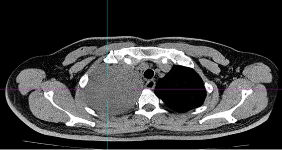 52岁男子咳嗽3个月老不好，到医院一查发现16cm巨型肿瘤