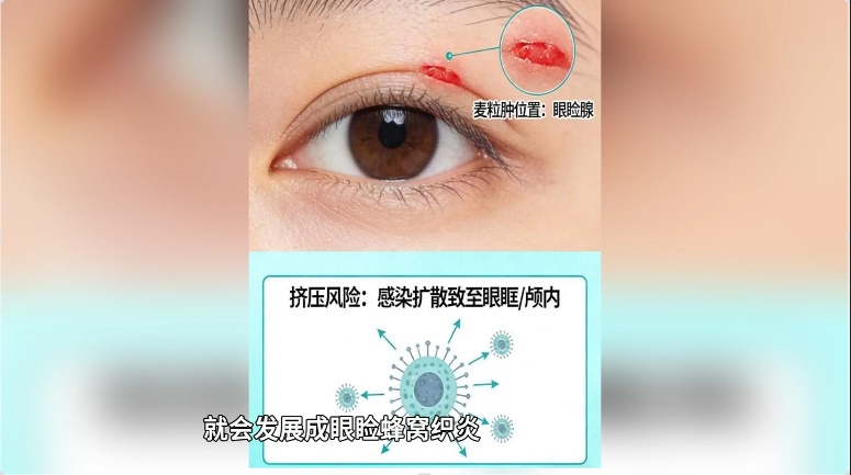 男子将眼旁麦粒肿当痘痘挤，眼睛差点“报废”