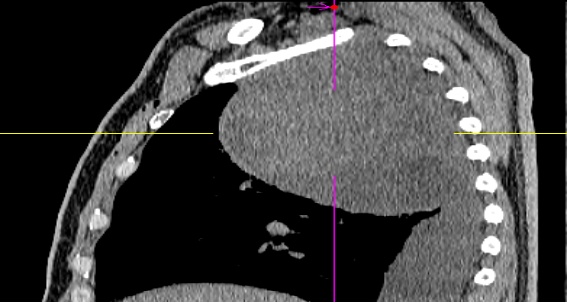 52岁男子咳嗽3个月老不好，到医院一查发现16cm巨型肿瘤