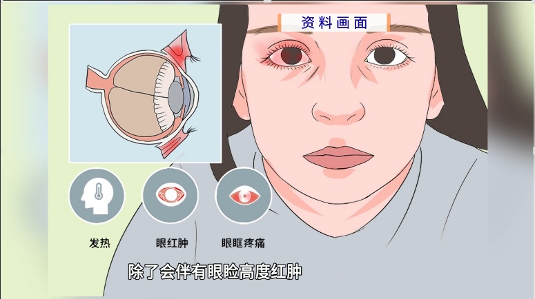 男子将眼旁麦粒肿当痘痘挤，眼睛差点“报废”