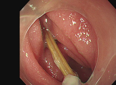 千万别再这样喝水!男子误吞牙签险穿肠,医院紧急接诊 千万别再这样喝水!男子误吞牙签险穿肠,医院紧急接诊