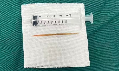 千万别再这样喝水!男子误吞牙签险穿肠,医院紧急接诊 千万别再这样喝水!男子误吞牙签险穿肠,医院紧急接诊