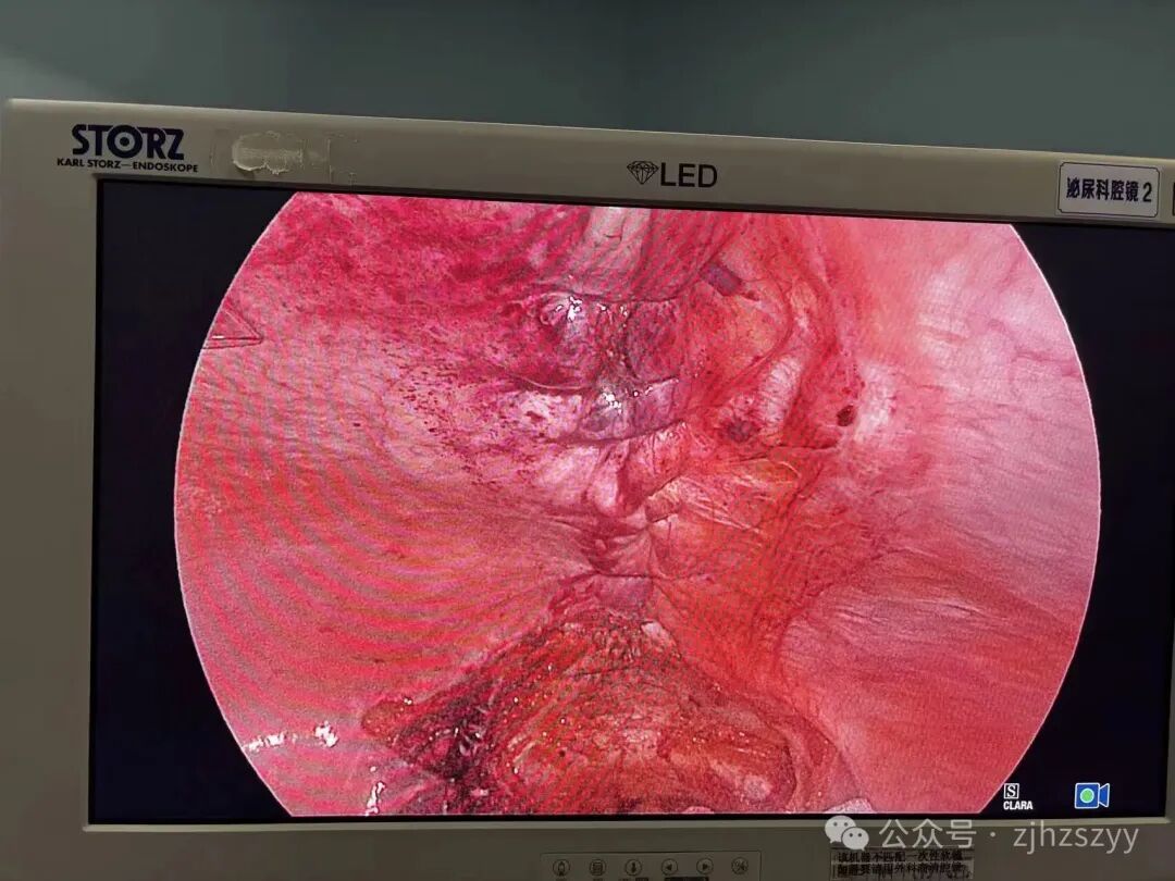 太可怕! 辣妈模仿明星,,肚子练出“大洞”肠子跑出来了…医生紧急提醒:普通人不要学 太可怕! 辣妈模仿明星,,肚子练出“大洞”肠子跑出来了…医生紧急提醒:普通人不要学