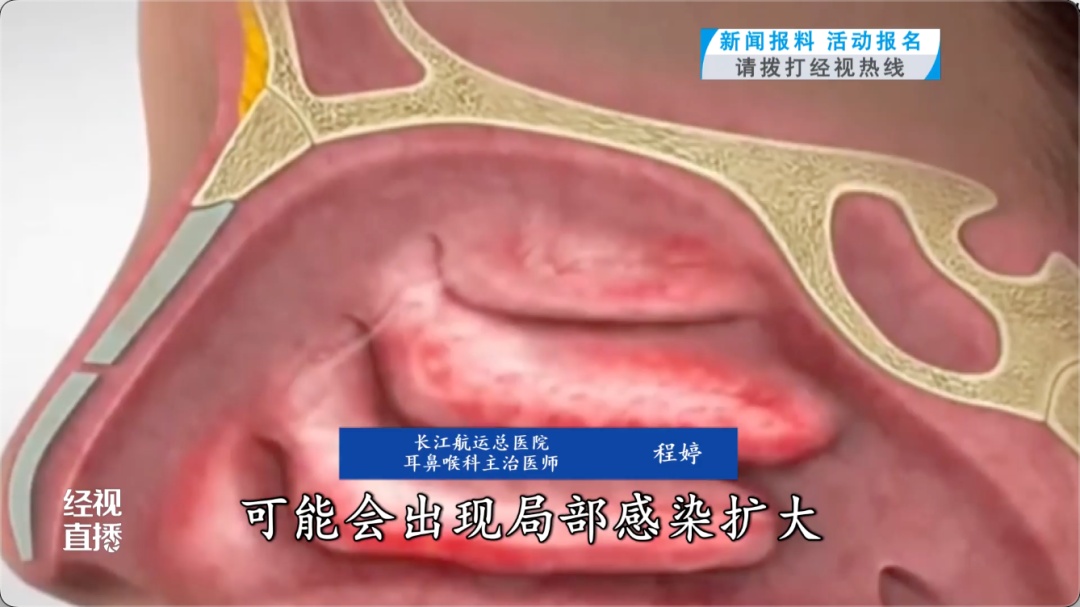 拔几根鼻毛，武汉男子半张脸肿了，说话、咀嚼都受影响，医生：严重可能导致颅内感染