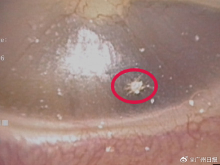 男子耳鸣两周夹出一只小蜘蛛 男子耳鸣两周夹出一只小蜘蛛