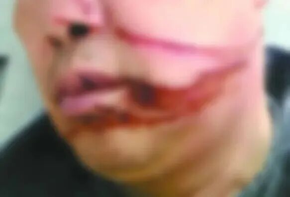 男子骑摩托过桥时被风筝线割脸，提醒→