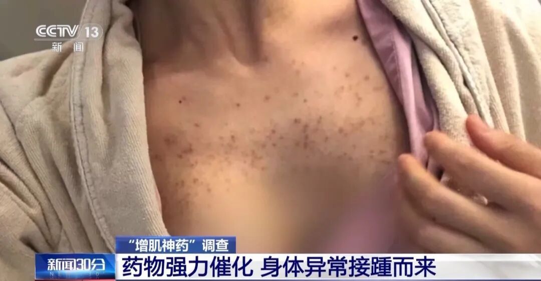 女子打增肌针长出喉结!央视披露“增肌神药”竟是马用兽药…… 女子打增肌针长出喉结!央视披露“增肌神药”竟是马用兽药……