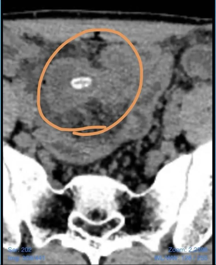 扬州21岁大学生突然剧烈腹痛，元凶竟是它……一定要小心！