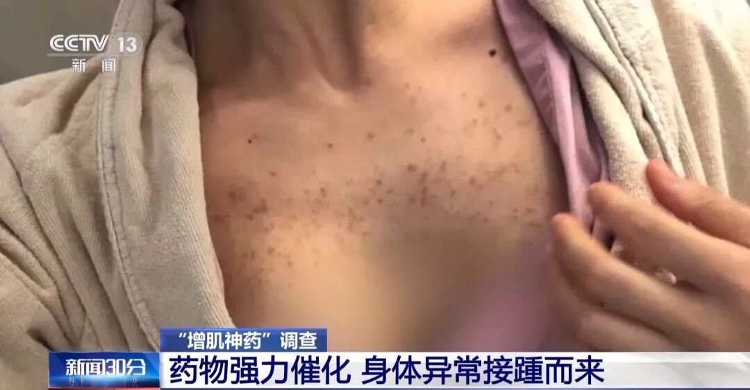健身账号大肆兜售“增肌神药”，成分中竟包含兽药，女子注射后长出喉结！央视披露→