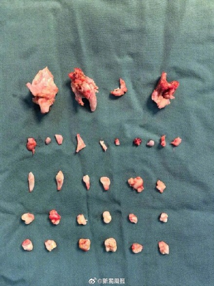 18女孩跳操腹痛不止腹中发现巨大肿块,18岁女孩腹中肿块里还有24颗牙齿 18女孩跳操腹痛不止腹中发现巨大肿块,18岁女孩腹中肿块里还有24颗牙齿