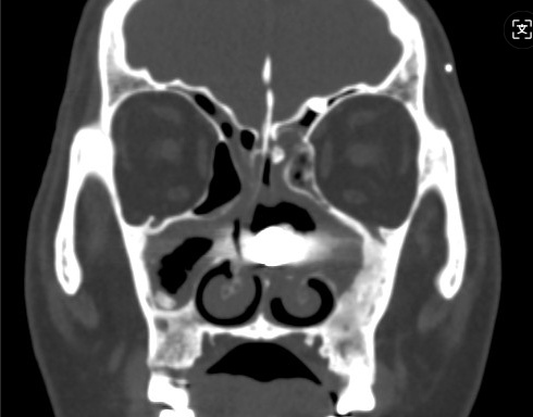 男子鼻子不舒服3个月，医生取出“藏”了40年的螺丝钉