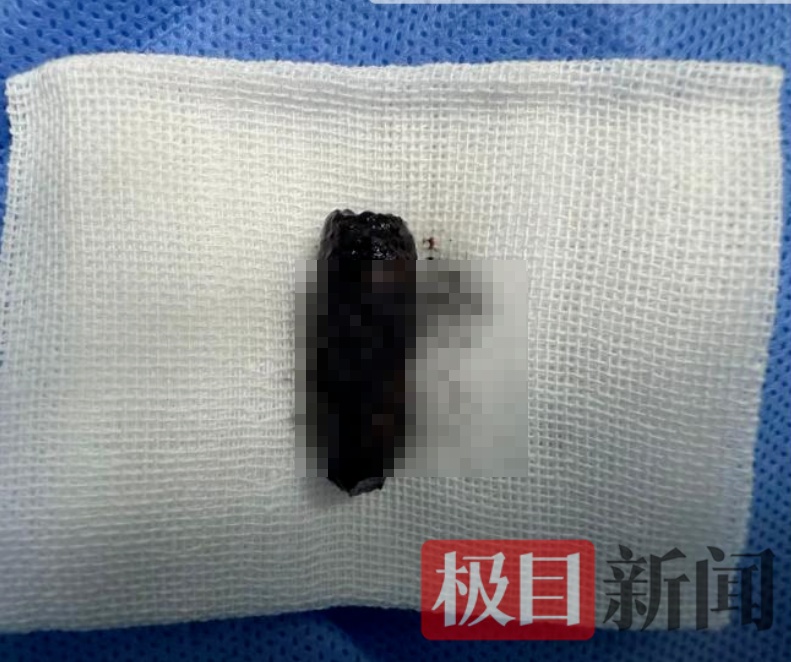 男子鼻子不舒服3个月，医生取出“藏”了40年的螺丝钉