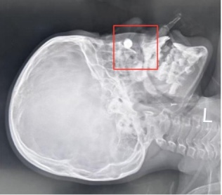 重症患儿出现“斗鸡眼”，医生揪出幕后元凶