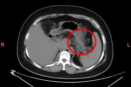 河南一女子长期吃油炸食品，抽出“牛奶血”，超标34倍