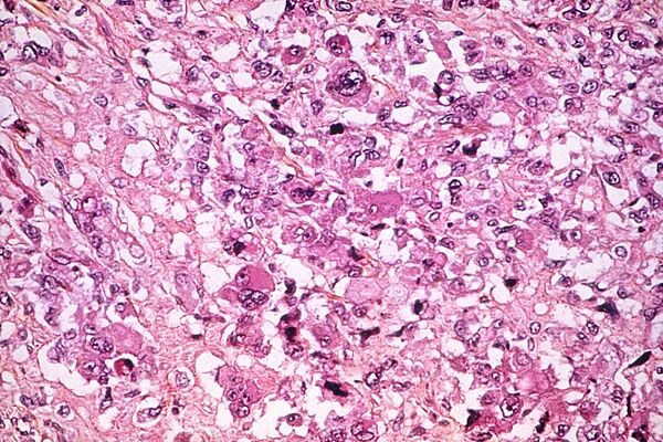 “小费同学”去世，年仅21岁，告别信让全网泪目！这种病恶化极快，我国每年新增4万例