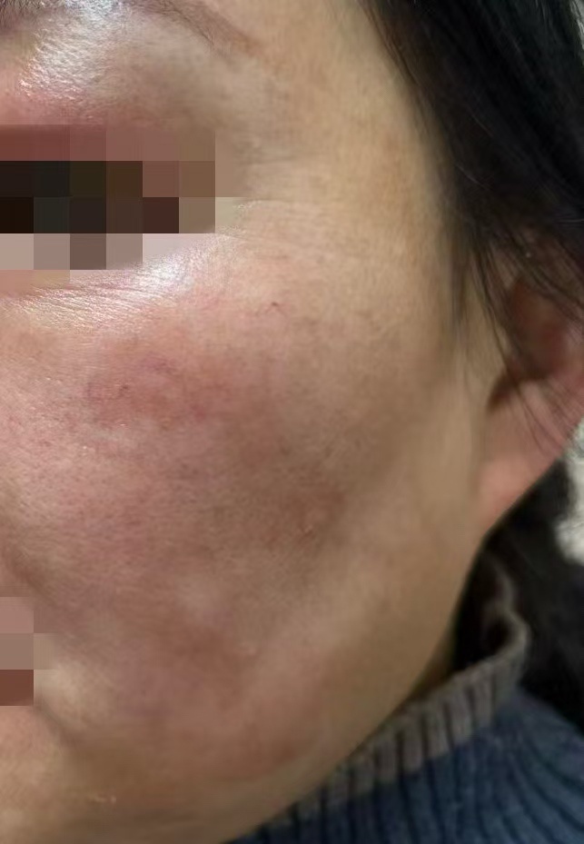 杭州41岁女子轻信美容院“快速祛斑”，结果变“花猫脸”！