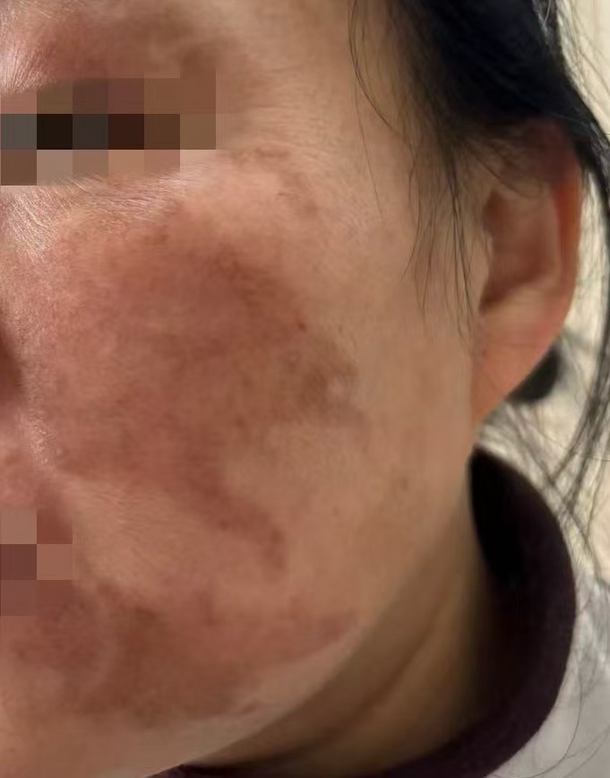 杭州41岁女子轻信美容院“快速祛斑”，结果变“花猫脸”！