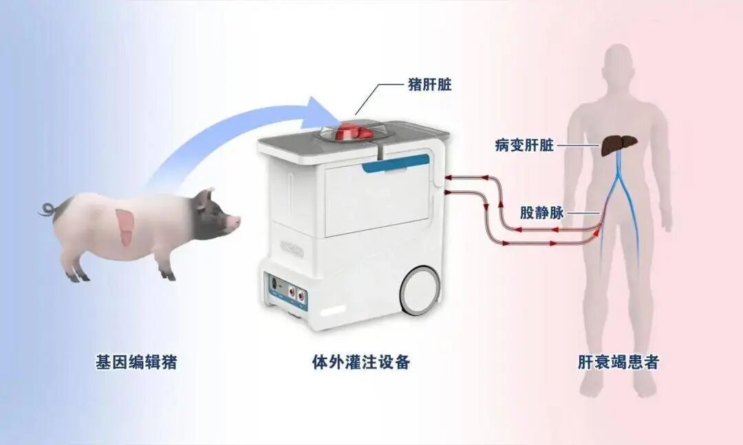 国际首例！肝衰竭患者命悬一线，医生用“外挂”猪肝临时代替肝脏，66小时后起死回生