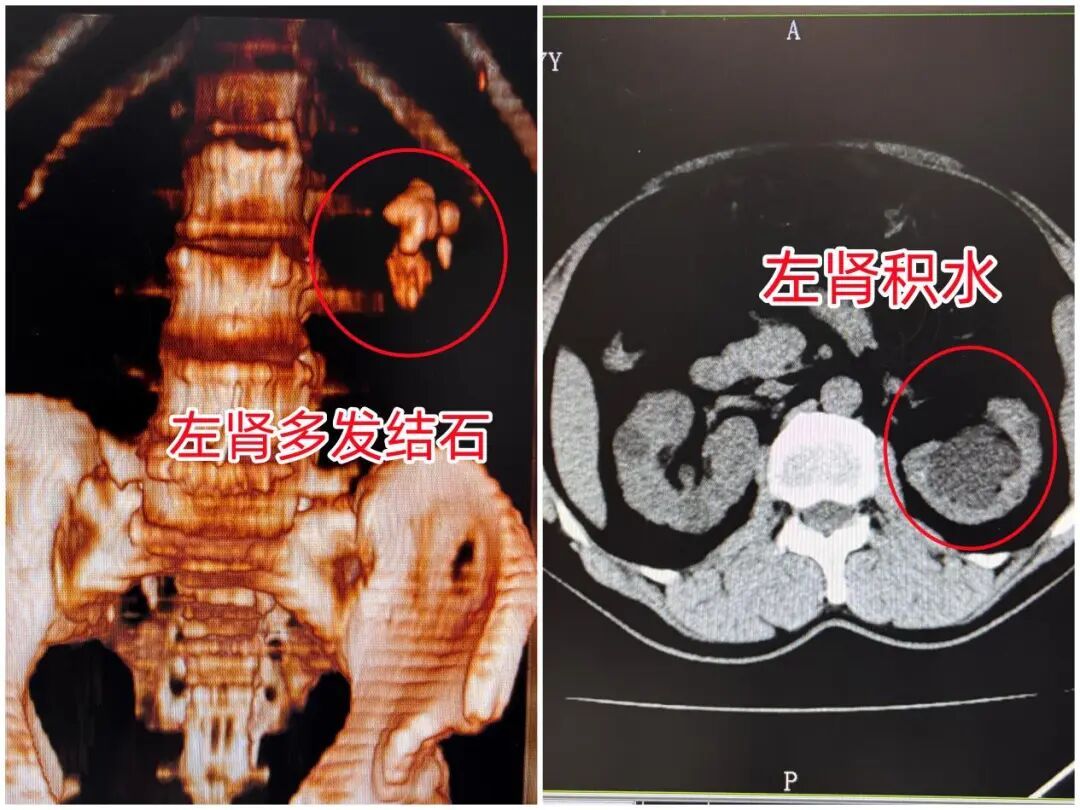 肾结石不痛就不用管？小心它“悄然夺走”健康肾脏