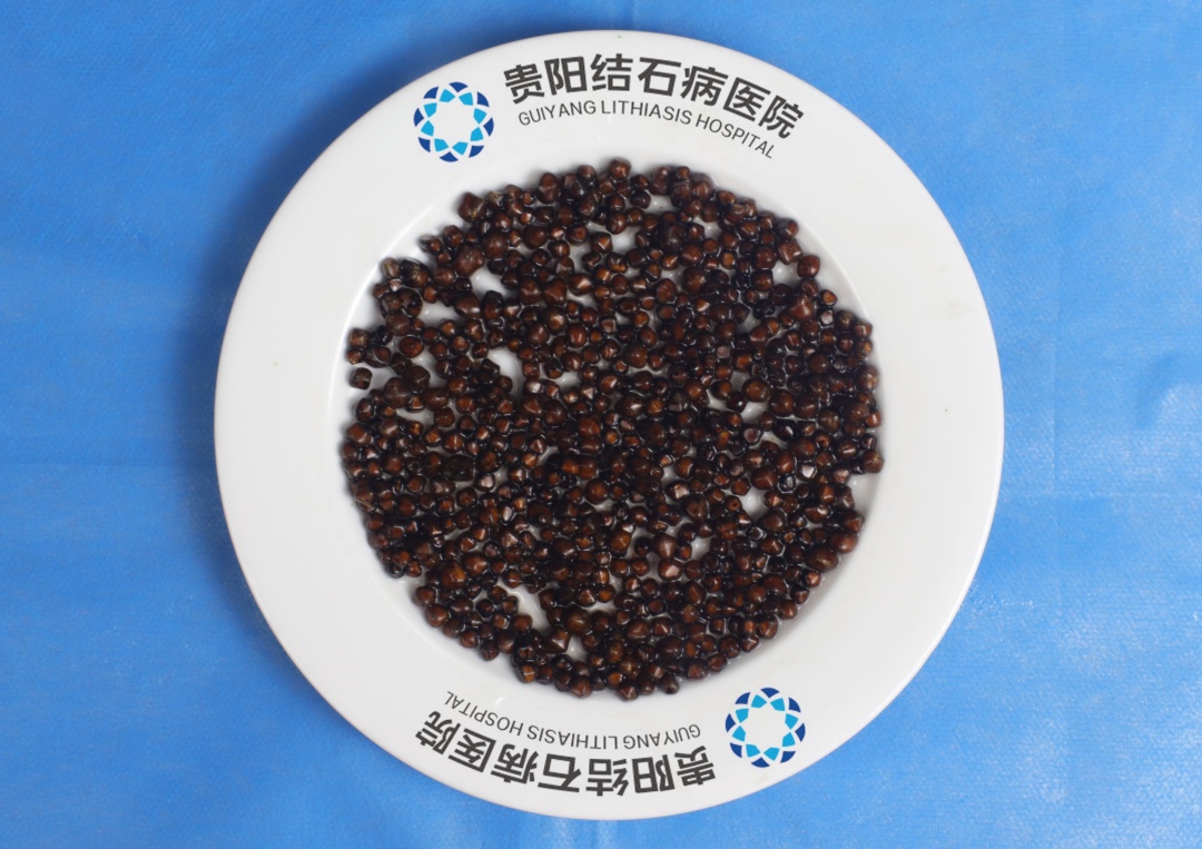 胆囊里面有“宝石”？千颗“石榴石”结石从贵阳七旬老人体内取出